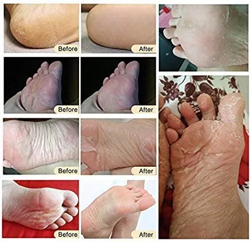 3 Pack Foot Peel Mask,Exfoliating Foot Socks Calluses Remover Dead Skin, Aloe Moisturizing Feet Peeling Mask for Dry Skin,Cracked Heels,Foot SPA Socks for Women and Men (Rose) Rose