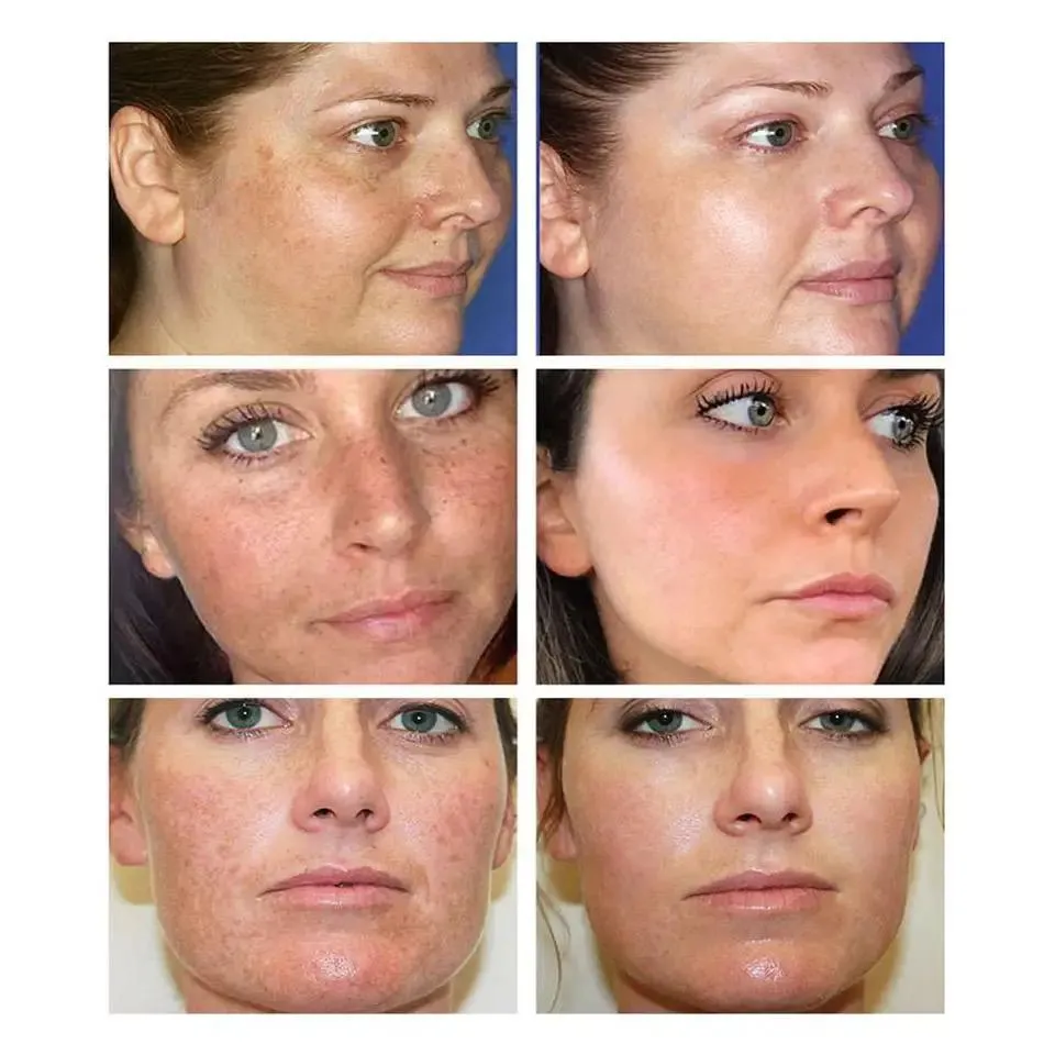 3ml Effective Whitening Freckle Vitamin C 20% Face - CHANCHI01