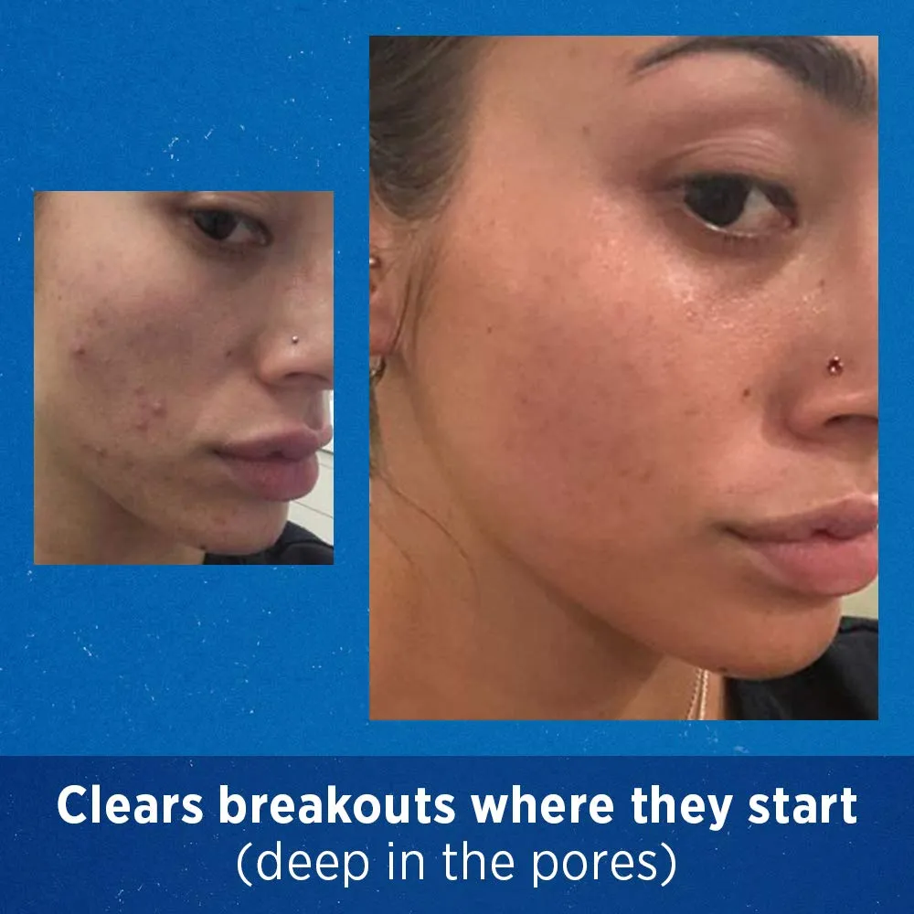 Acne Treatment Differin Gel for Face with Adapalene, Clears and Prevents Acne, Up to 30 Day Supply, 15g Tube