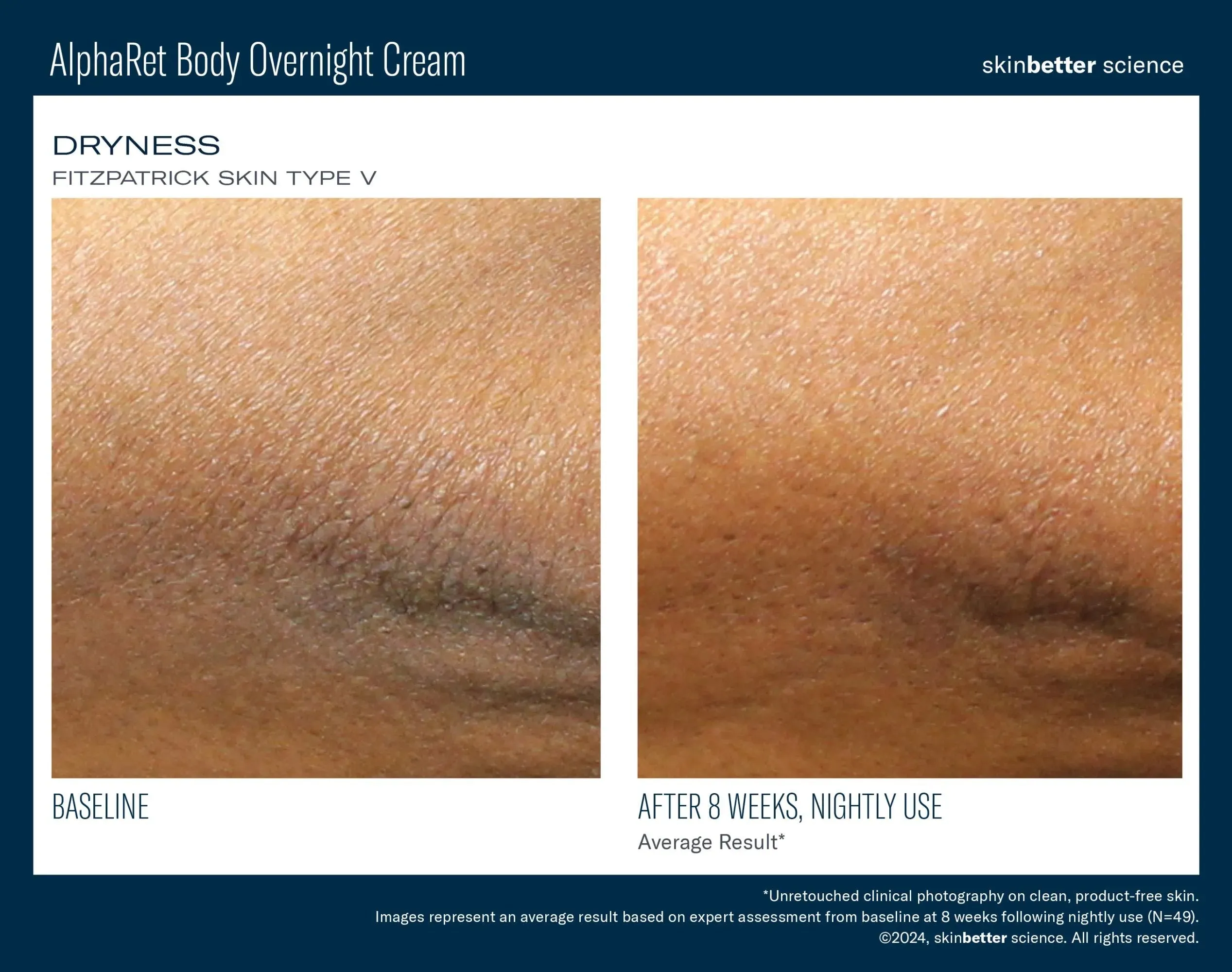 AlphaRet Body Overnight Cream