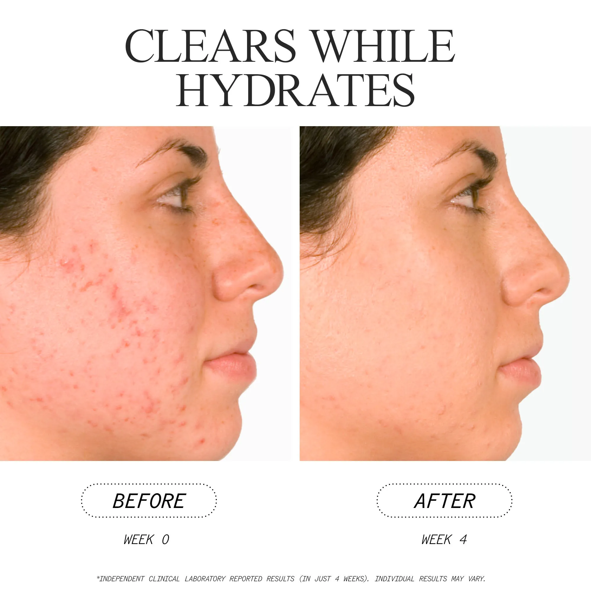 Blemish Clearing Salicylic Acid Serum