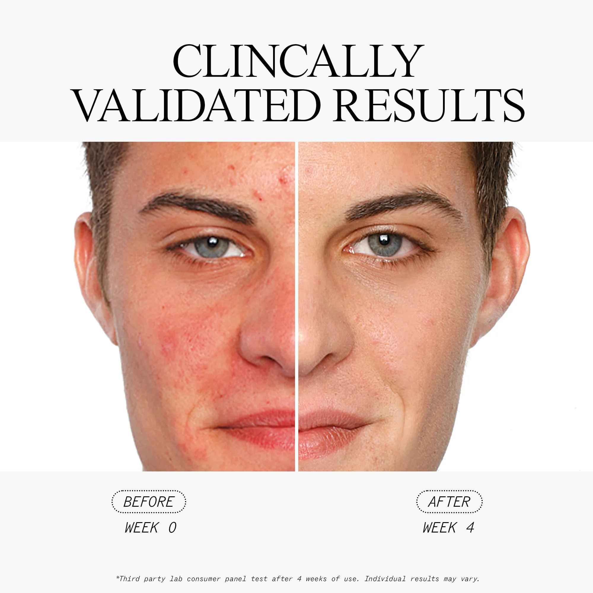 Blemish Clearing Salicylic Acid Serum
