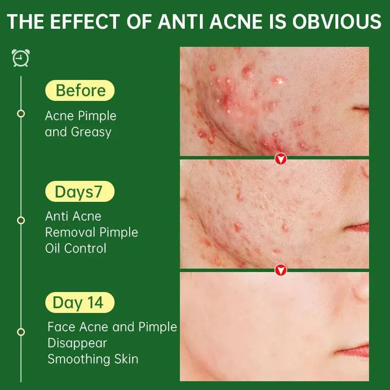 ClearSkin Herbal Acne Cream: Plant-Powered Skin Solution