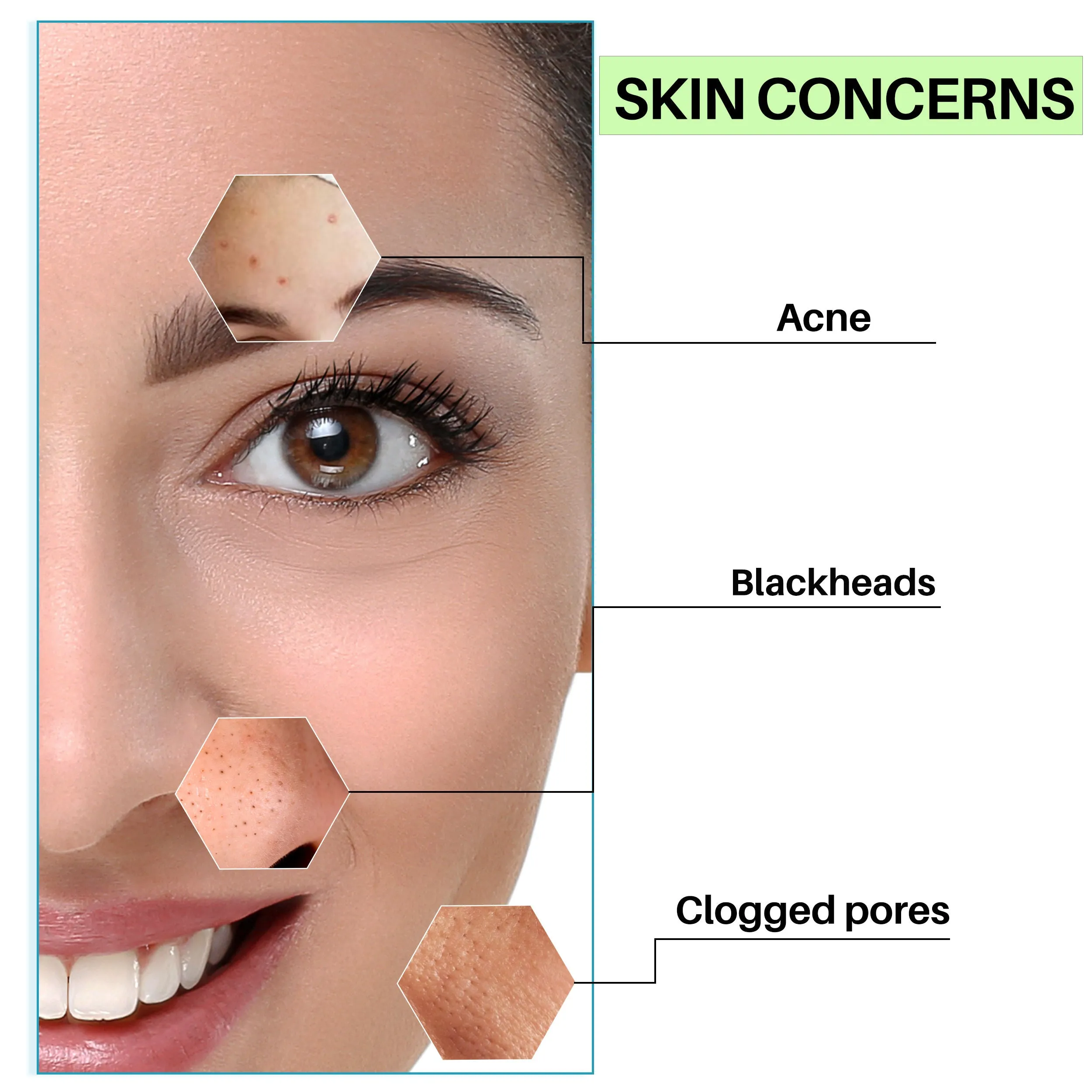 DermDoc 2% Salicylic Acid Face Serum (15 ml)| salicylic acid serum , blackheads remover , serum for oily skin , acne treatment , anti acne serum , acne scar removal , anti acne , salycylic acid serum