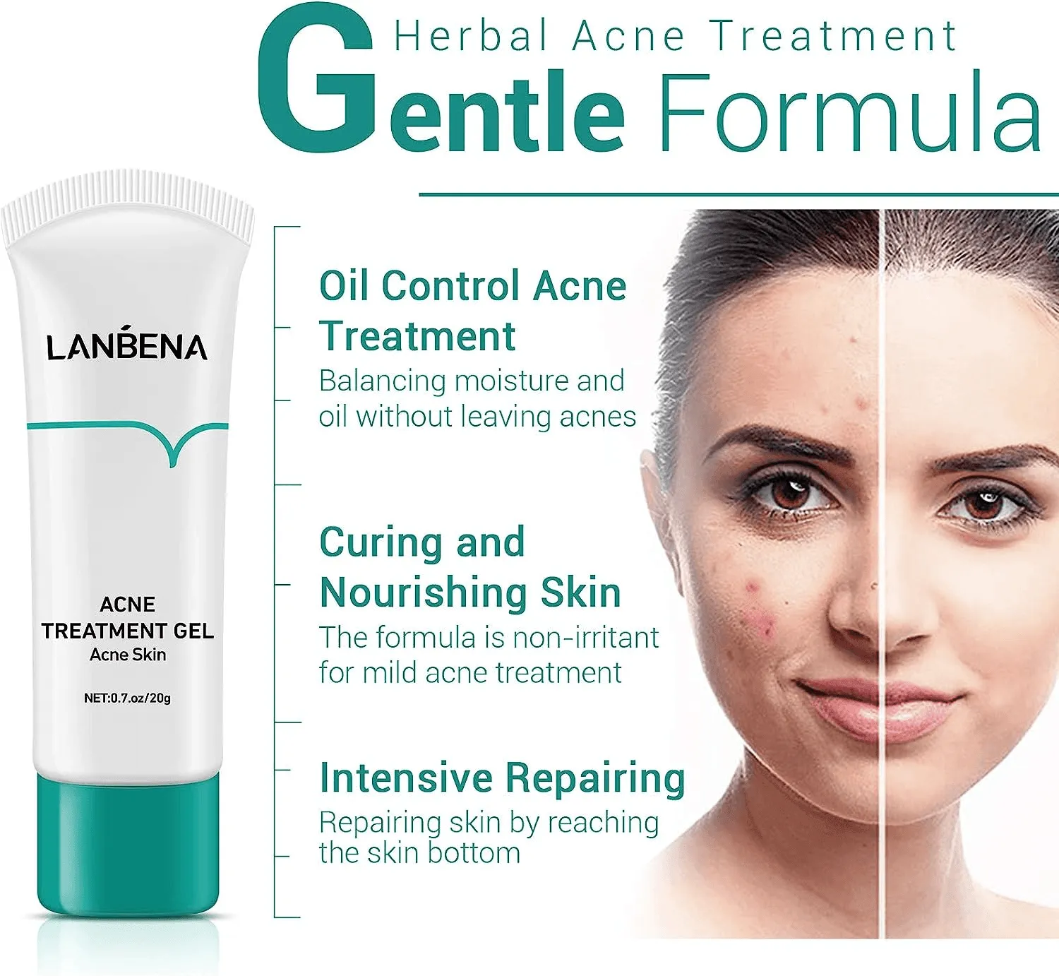 Lanbena Anti Acne Solution Gel - 20g