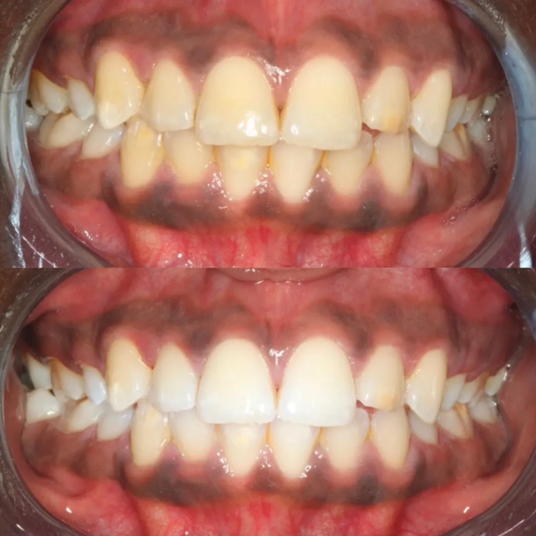 Teeth Whitening Kit