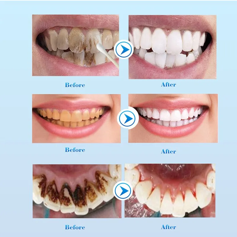 Teeth Whitening Serum Effective Remove Stains Plaque Deep Cleansing Dental Oral Hygiene Gel Teeth Whitening Kit Beauty Health